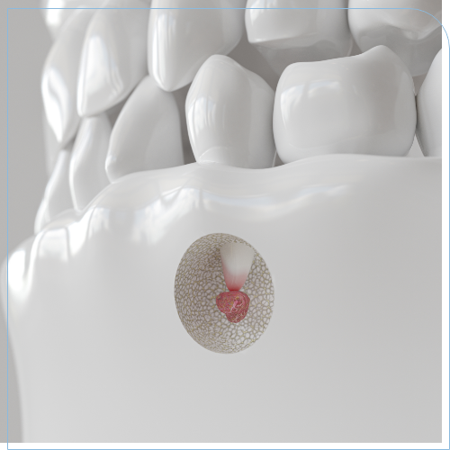 Illustration of a small bump under the root of a tooth