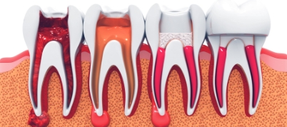 Illustration of four different stages of cracked tooth treatment