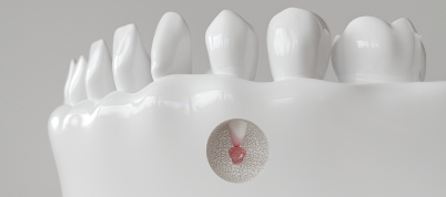 Illustration of a small bump below the root of a tooth