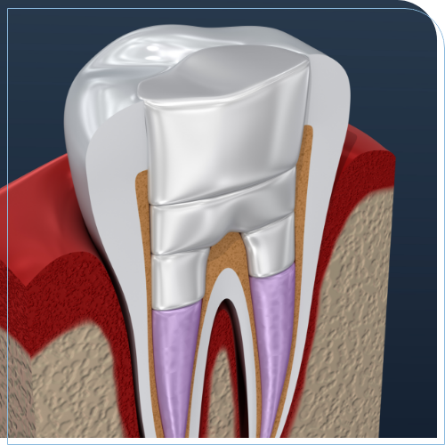 Illustrated tooth that has been treated with a root canal