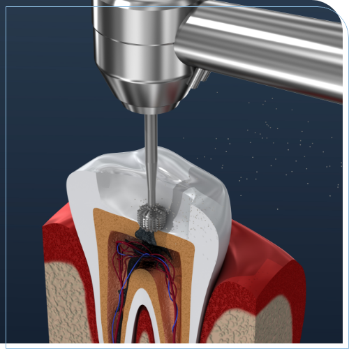 Illustration of a traditional dental instrument drilling into the center of a tooth