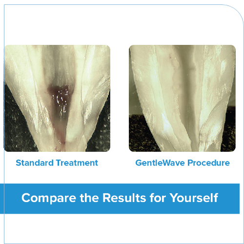 Tooth that received a traditional root canal with some bacteria left over next to a tooth with no bacteria left after Gentle Wave