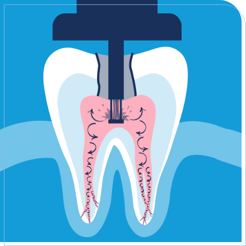 Illustration of a dental instrument disinfecting the inside of a tooth
