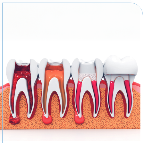 Illustration of the four stages of treating a decayed tooth with a root canal