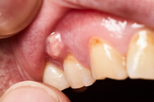 Close up of a dental abscess